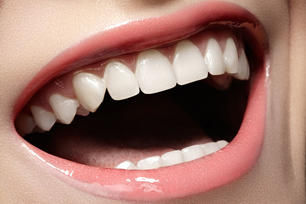 Dental Veneers